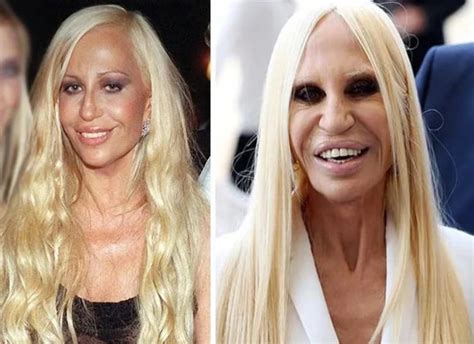 plastic surgery versace